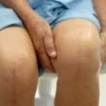 diary-of-a-total-knee-replacement -|-sixty-and-me