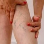 a-clinical-aromatherapy-approach-to-varicose-veins-|-sixty-and…