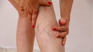 A Clinical Aromatherapy Approach To Varicose Veins | Sixty And&hellip;